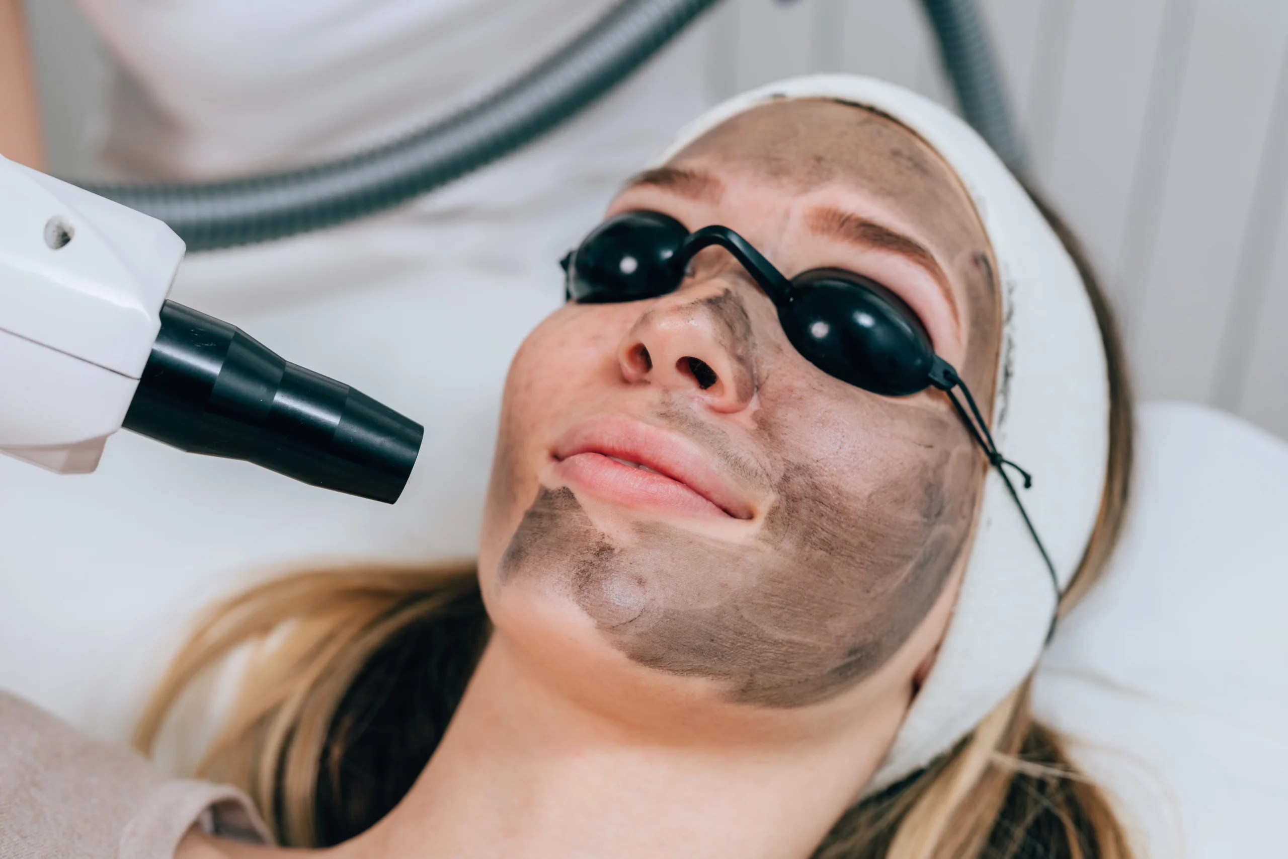 LASER for Pigmentation